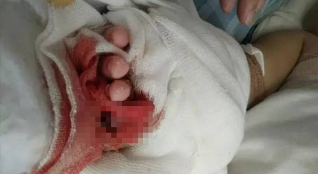 雪上加霜!烧伤女婴送医治疗又遇蠢医生 小指被剪断