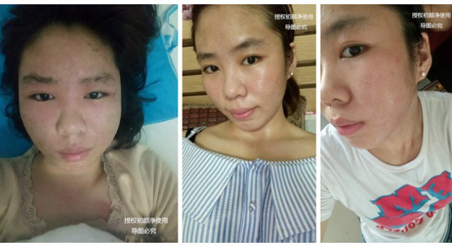 治愈激素脸最好的方法,激素脸如此治疗才最彻底