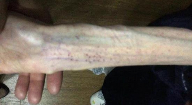 21岁女生减肥厌食至25公斤 手术后醒来即要吃东西