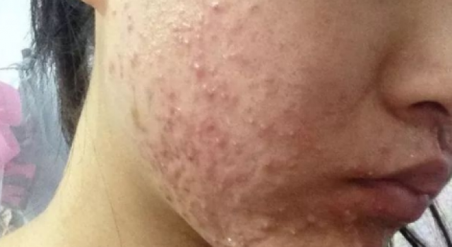 激素脸满脸疹子怎么办?激素脸排毒排出小疙瘩