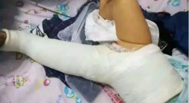 婴儿被狗撞伤残怎么回事?撞成十级伤残还跑路?