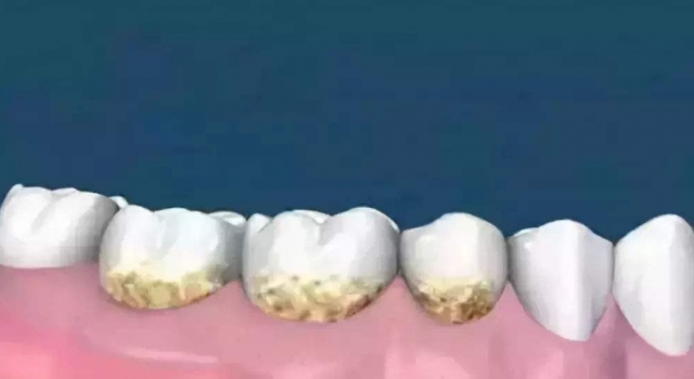 处理牙结石的五个土办法 省钱还省力