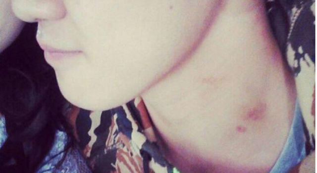 吻要人命！女子在17岁男友脖子留吻痕 致其血栓离世