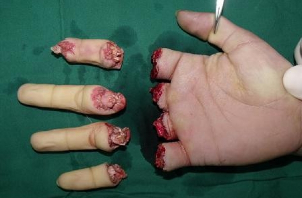 女工10根手指被电锯锯断 及时手术21小时全部接活