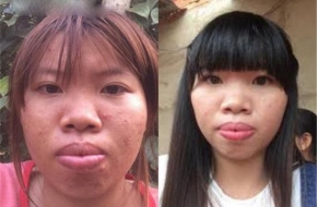 越南女子花十万整容闪婚嫁给富二代 之前真的太丑了！