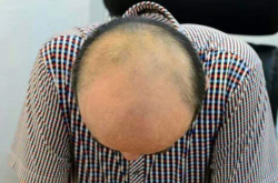 脱发更长寿上热搜 网友：我宁肯早死