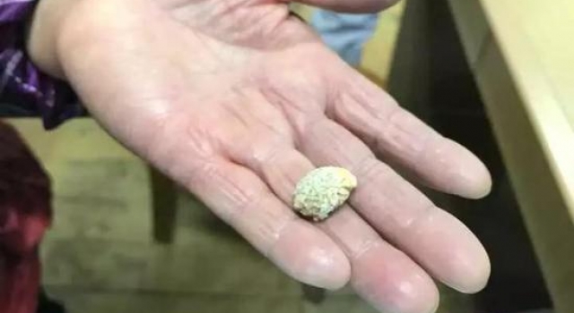 咳嗽喷出石头被赞幸运 免了手术还保住了扁桃体