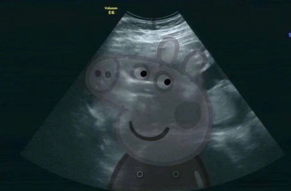 张歆艺怀孕 晒B超照都这么社会这个妈妈很皮啊!