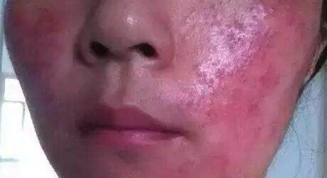 激素脸反黑正常吗？激素脸反黑多久才会白