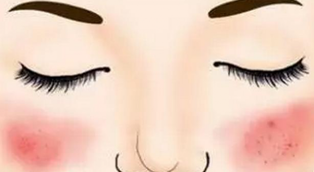 激素脸为什么泛红不退？激素脸角质层受损严重能修复好吗