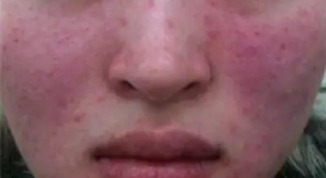 用什么方法修复激素脸？如何快速修复激素脸