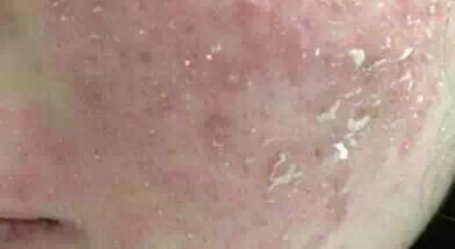 激素脸用什么方法补水?激素脸干燥紧绷脱皮怎么办