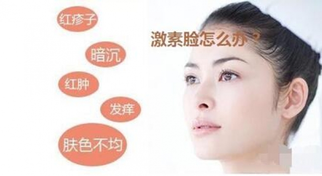 激素脸可以治疗好吗？那么激素脸应该怎么治疗