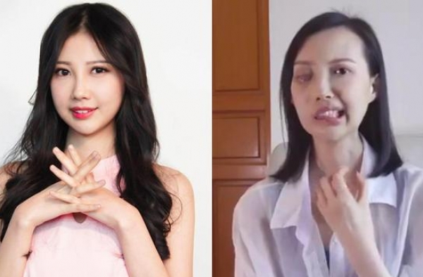 美女歌手患罕见癌症致毁容，连眼珠都动不了，大刘曾资助她
