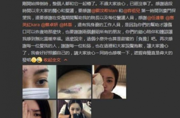 阿娇晒伤口照片怎么回事？阿娇是怎么受伤的？
