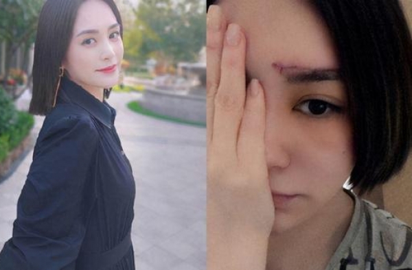 阿娇爆头留蜈蚣疤 秘密回港做医美　磨皮去疤需3个月后再评估