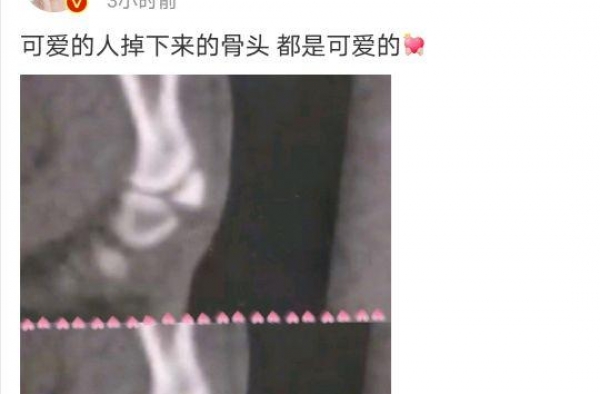 张嘉倪发文自曝受伤，骨头掉下来了，配文：连骨头都是可爱的呢